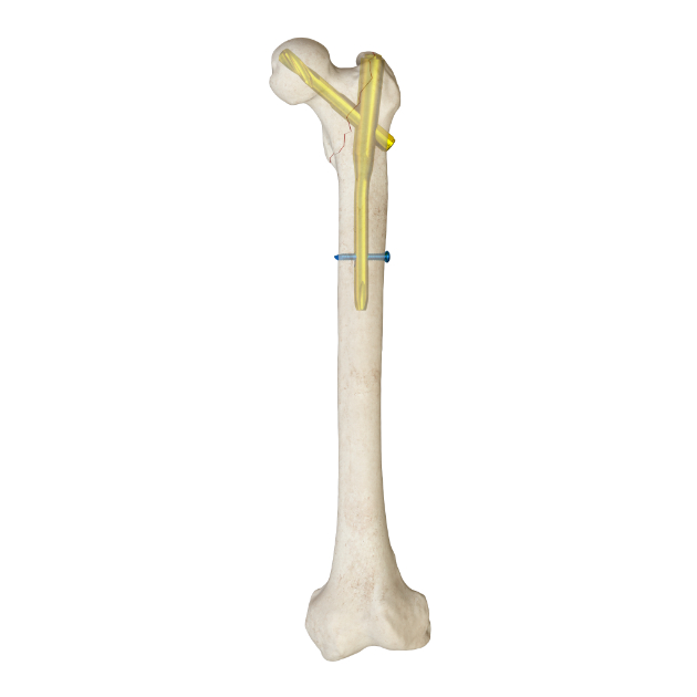 MR-IM Femoral Nail