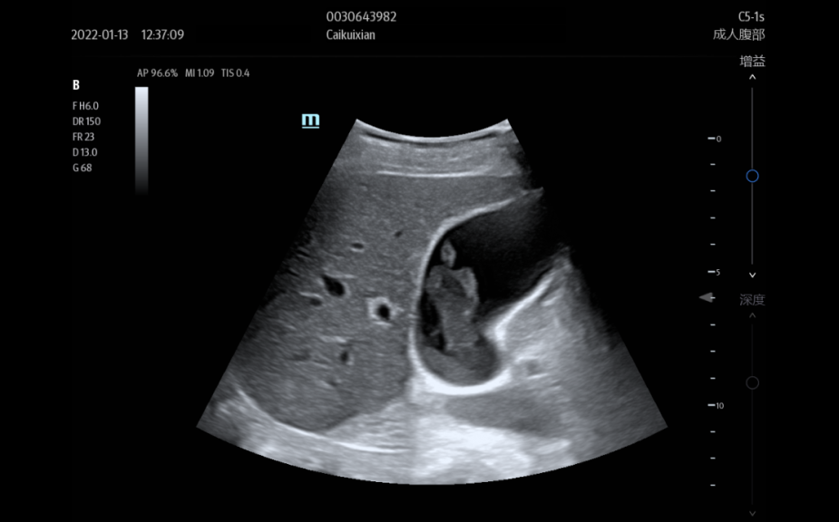 C5-1s_GB_Cholestasis-925x576