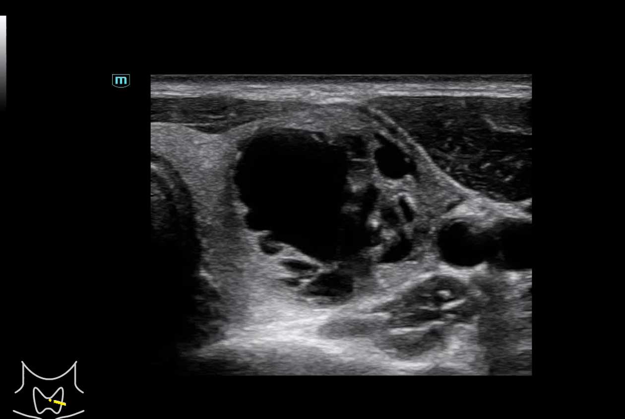 2D Complex Thyroid Lesion N9