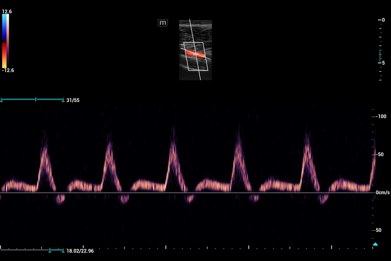 Lower_arterial_Triplex_N9_HD_Zoom_1260x844