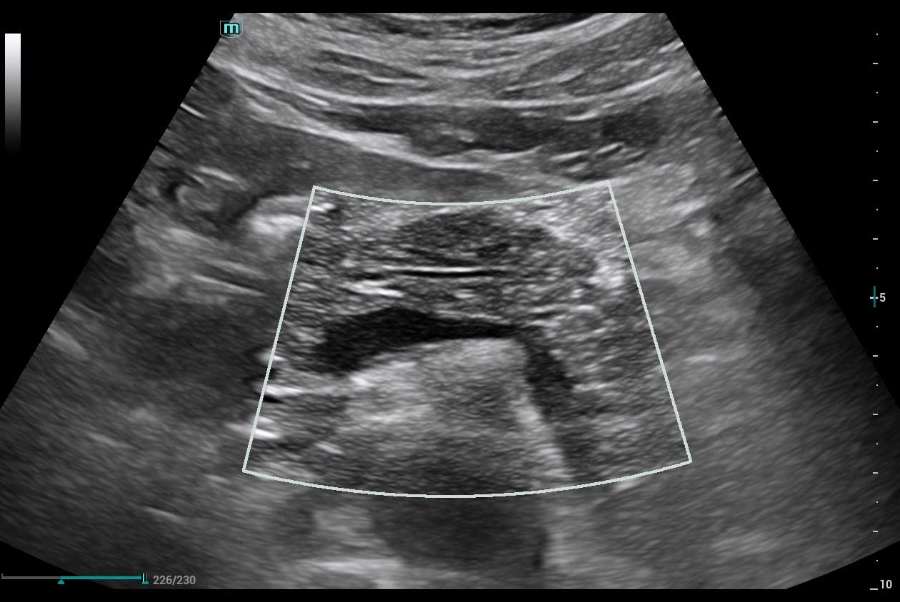 Pancreas_w_HD_Scope_N9_HD_Zoom_1260x844