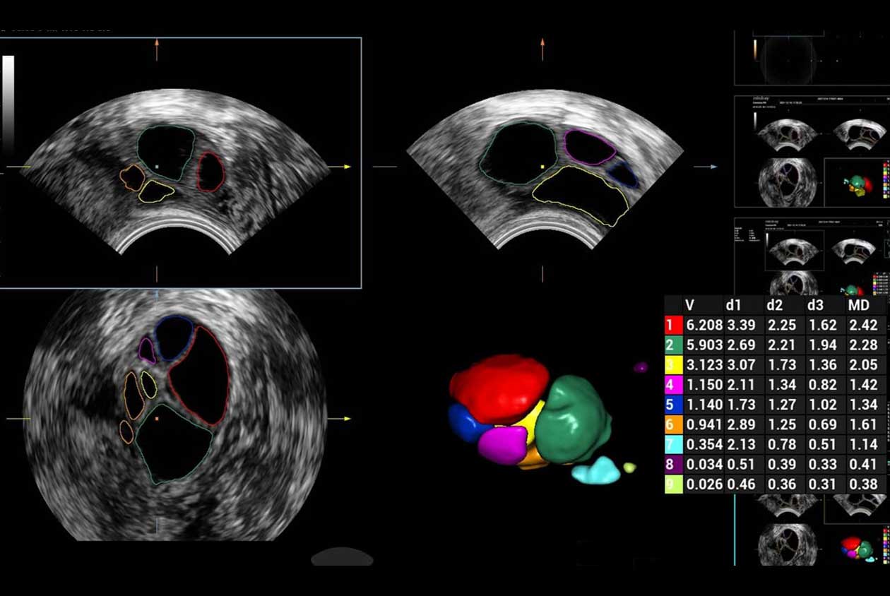 Smart_Follicle_N9_HD_Zoom_1260x844