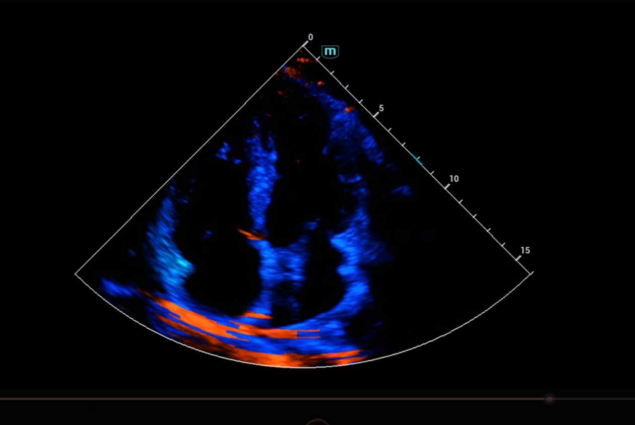 Tissue_Doppler_N9_HD_Zoom_1260x844