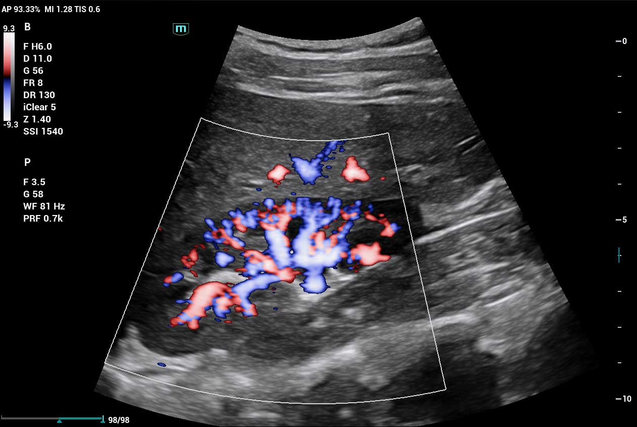Bi Directional Power Doppler HR Flow 