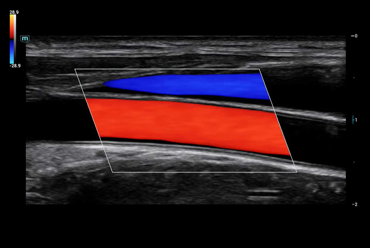 color_doppler_artery_n9_1260x844