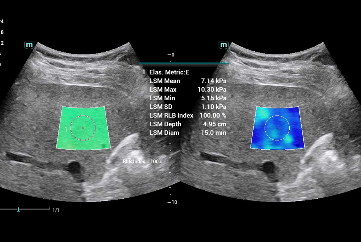 Sound Touch Elastography N9