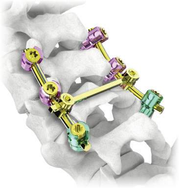 MS Posterior Pedicle Screw System