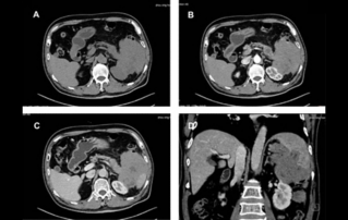 Ultrasound Journal 7: ?? ??? ?? ???(Rare Primary Pancreatic Lymphoma)? ??? ?? ??? ??(CEUS) ??